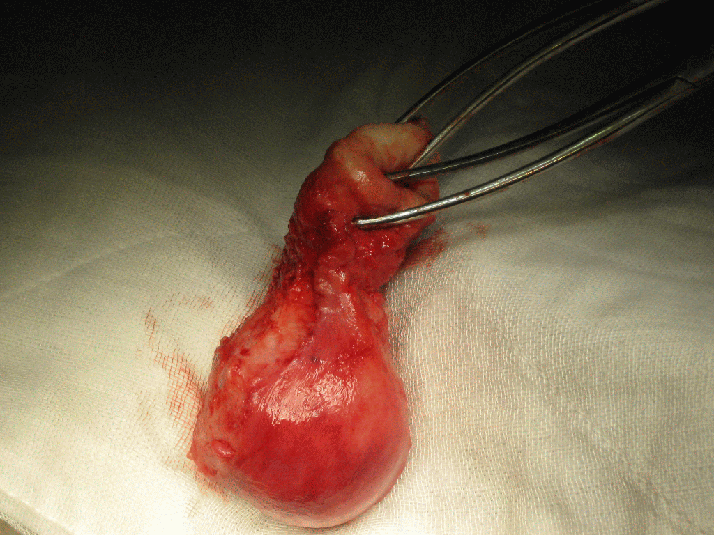 vaginal hysterectomy uterine specimen1